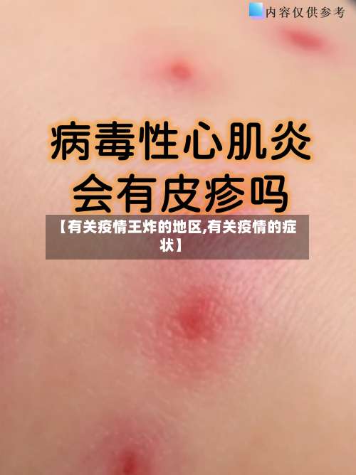 【有关疫情王炸的地区,有关疫情的症状】-第1张图片